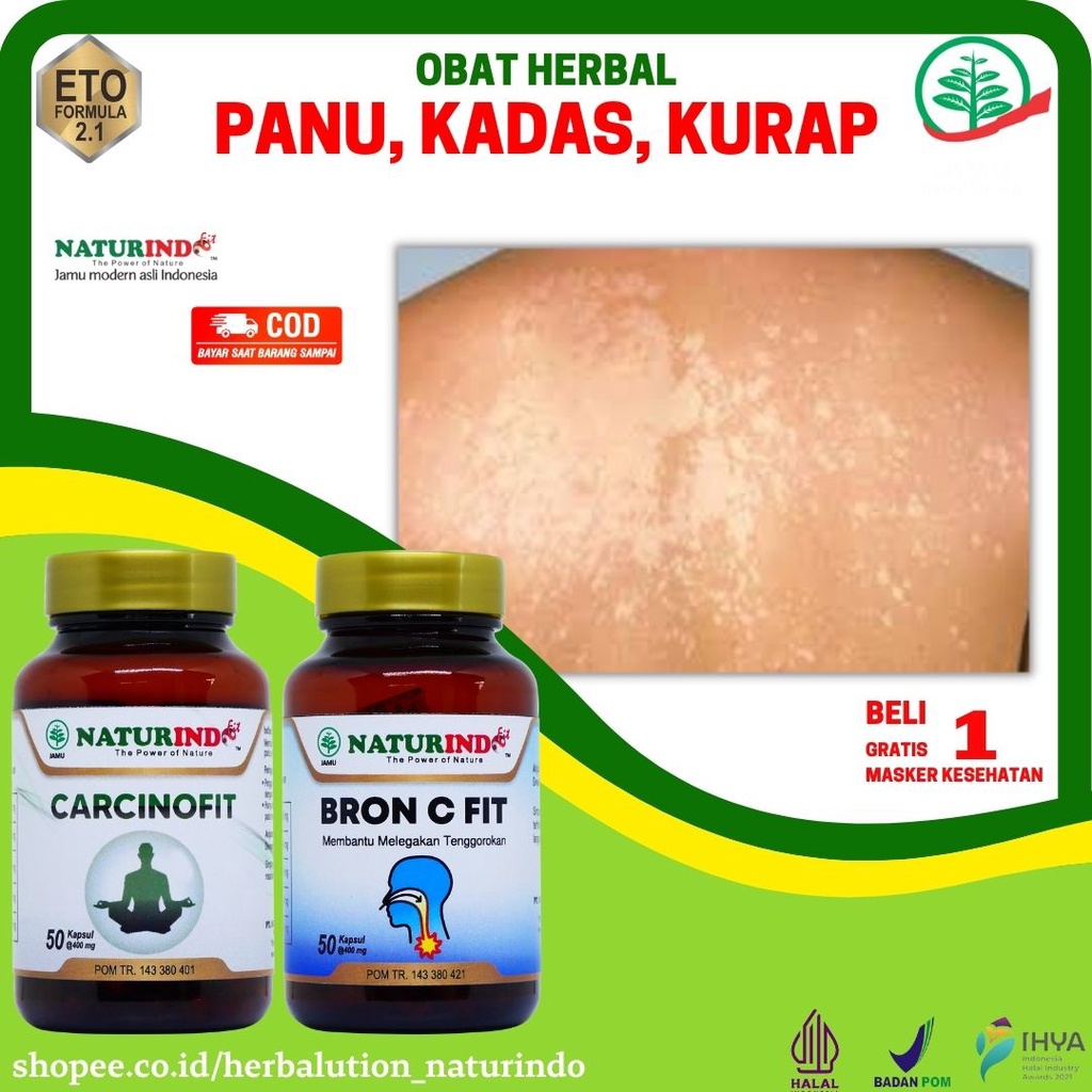 Obat Panu Jamur Kulit Kadas Kurap Paling Ampuh 100% Panu Anak Di Wajah Obat Kadas Kurap Jamur Selang
