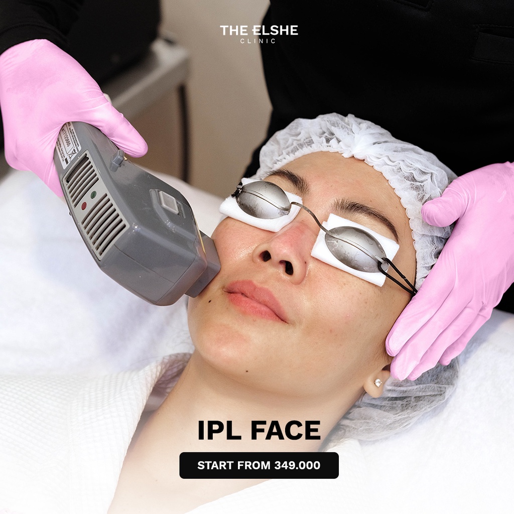 IPL Treatment The Elshe Clinic