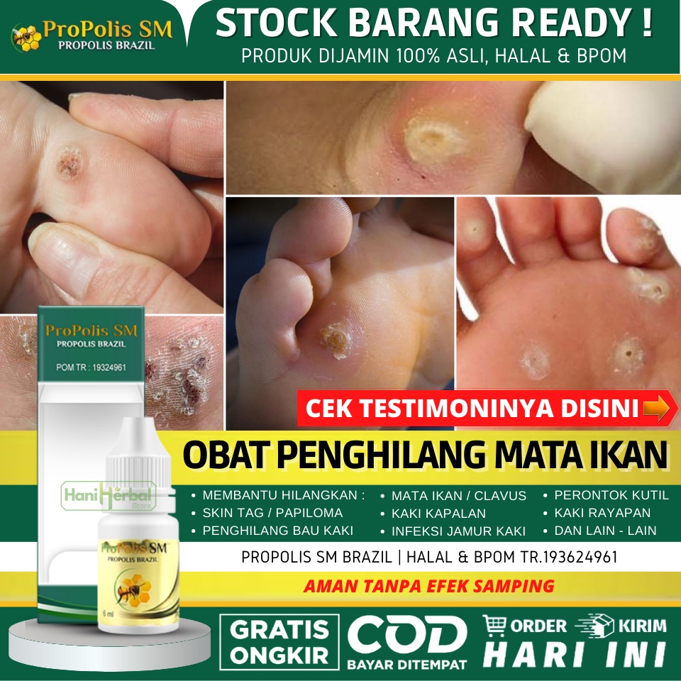 [COD] OBAT MATA IKAN  - OBAT MATA IKAN DI TELAPAK KAKI - OBAT MATA IKAN DI TANGAN - PROPOLIS SM ASLI