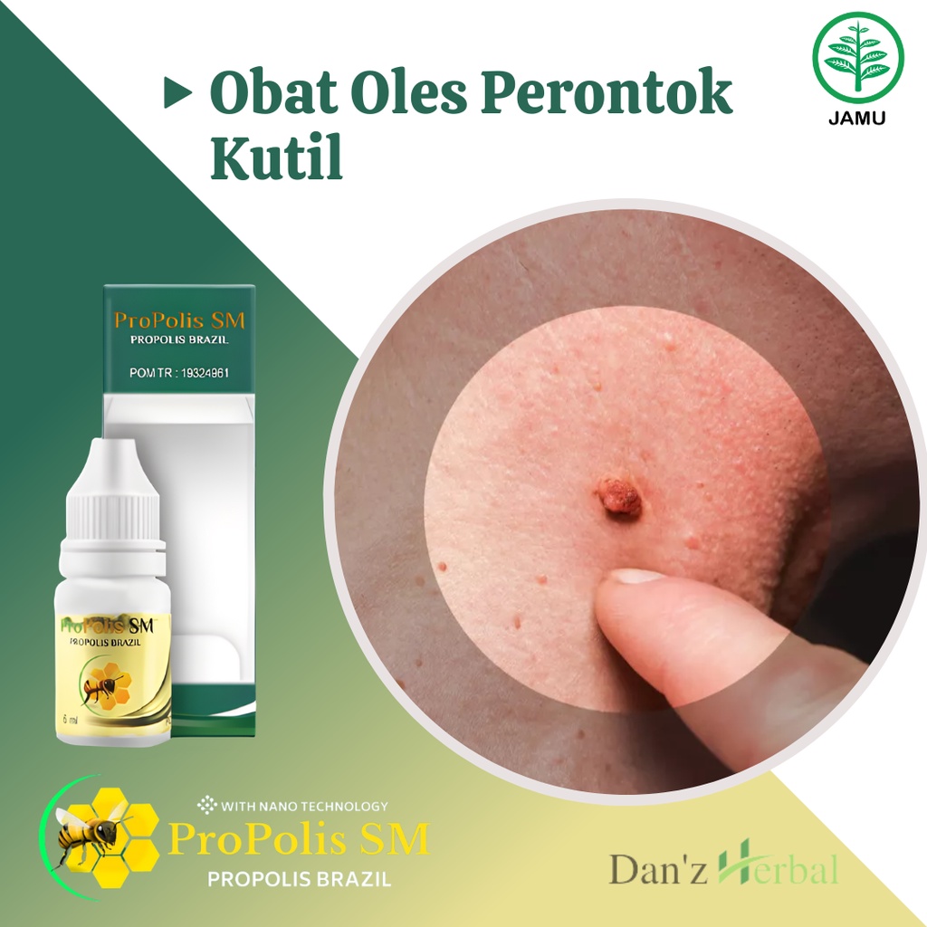 Obat Kutil, Obat Kutil di Jari Tangan, Obat Kutil di Tangan, Obat Oles Kutil, Obat Penghilang Kutil,