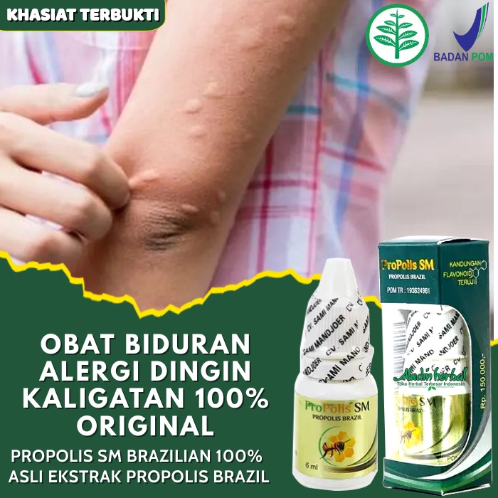Obat Gatal Biduran Menahun - Alergi Dingin, Kaligata, Bentol biduran Infeksi jamur dll - Propolis SM