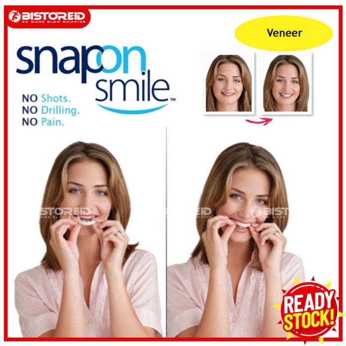 BSID SET VENEER PELAPIS GIGI OMPONG - SEPASANG ATAS DAN BAWAH