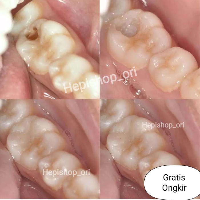 Tambal Gigi Bolong Penutup Gigi Berlubang Penambal Gigi Depan TCI