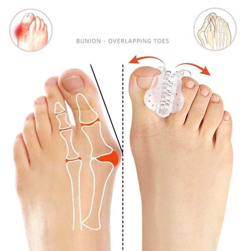 Mxbeauty Pemisah Jari Kaki Professional Toe Orthotics Brace Feet Bone Thumb Adjuster Alat Perawatan Kaki Pelindung Kaki Korektor Pelindung Kaki Jempol Kaki Valgus Adjuster