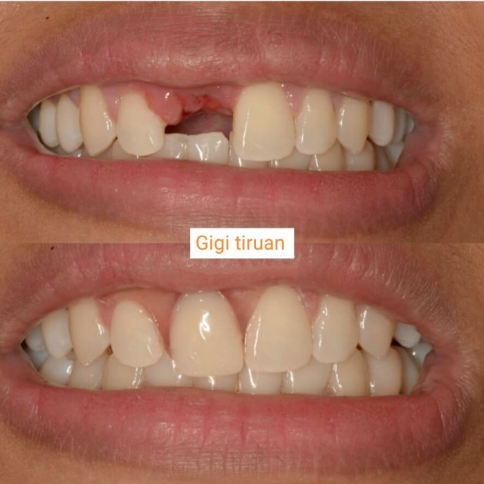 Gigi Palsu Lepas Pasang Gigi Palsu Penambal Gigi Ompong Penutup TCI