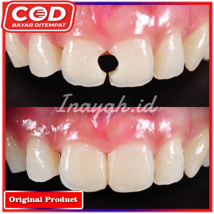 GIGI PALSU PENAMBAL GIGI PATAH Penyambung gigi patah TCI