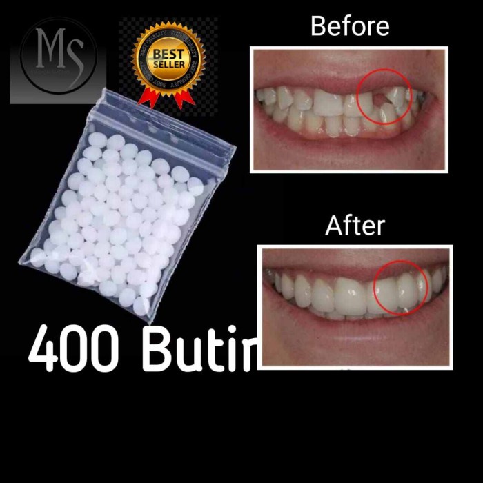 400 Butir Penambal Gigi Ompong Gigi Kuning Gigi Tidak Rata Gigi TCI