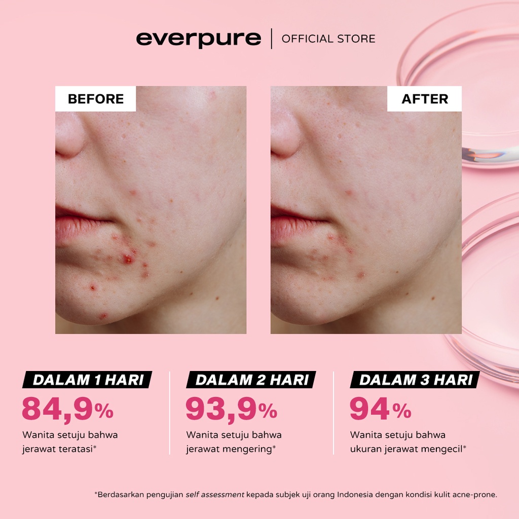 ★ BB ★ Everpure Sul-Pure Acne Spot Drying Lotion 10ml - 20ml - Obat Totol Jerawat [BPOM]