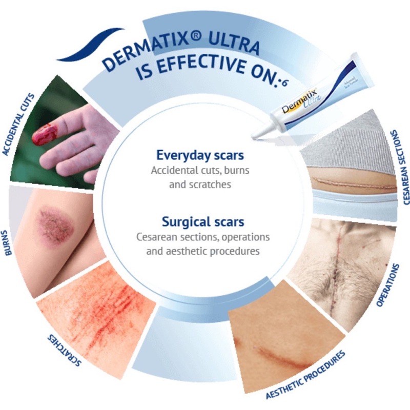 [ Dermatix Ultra ] Cream Penghilang Bekas Luka Operasi Iris Tergores Digigit Serangga Nyamuk / Luka Lama / Bakar / Gatal Hitam Koreng Di Kaki Oprasi Ampuh Advanced Scar Formula Gel Krim Wajah Keloid Stretchmark stretch mark Dermatik