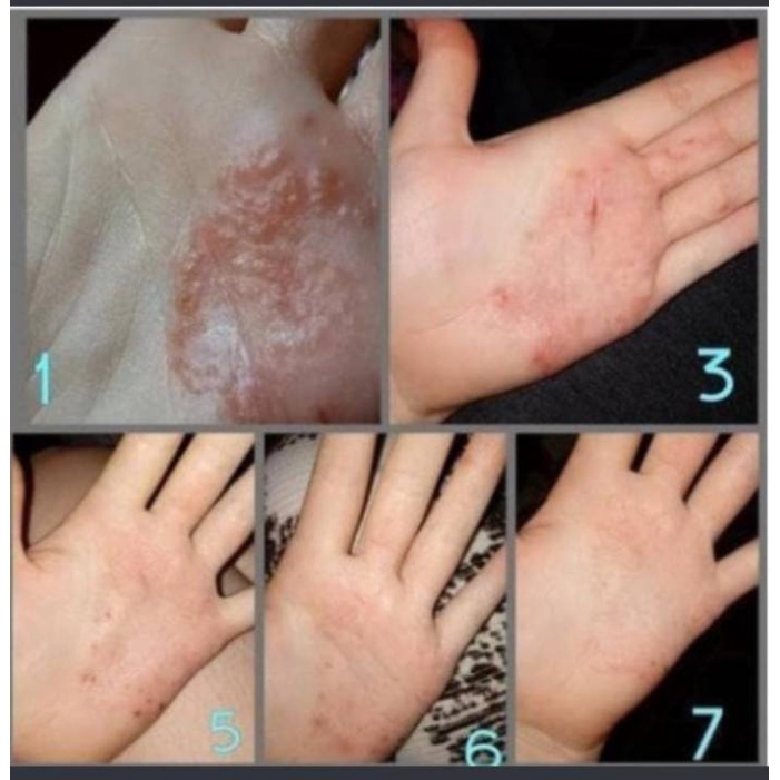 Obat Gatal 100% Original ZUDAIFU Salep Gatal Salep Kulit Jamur Dermatitis Psoriasis Eksim Jamur Kurap Alergi Kulit Cream Obat Gatal