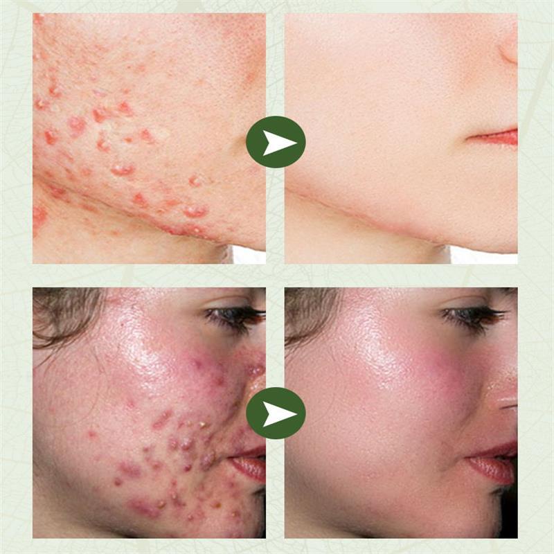 ZHENXIU Salicylic Acid Acne Treatment Cream 20Gr-Krim Anti Jerawat Salep Jerawat Menghilangkan Jerawat Memperbaiki Kulit Penghilang Bekas Luka
