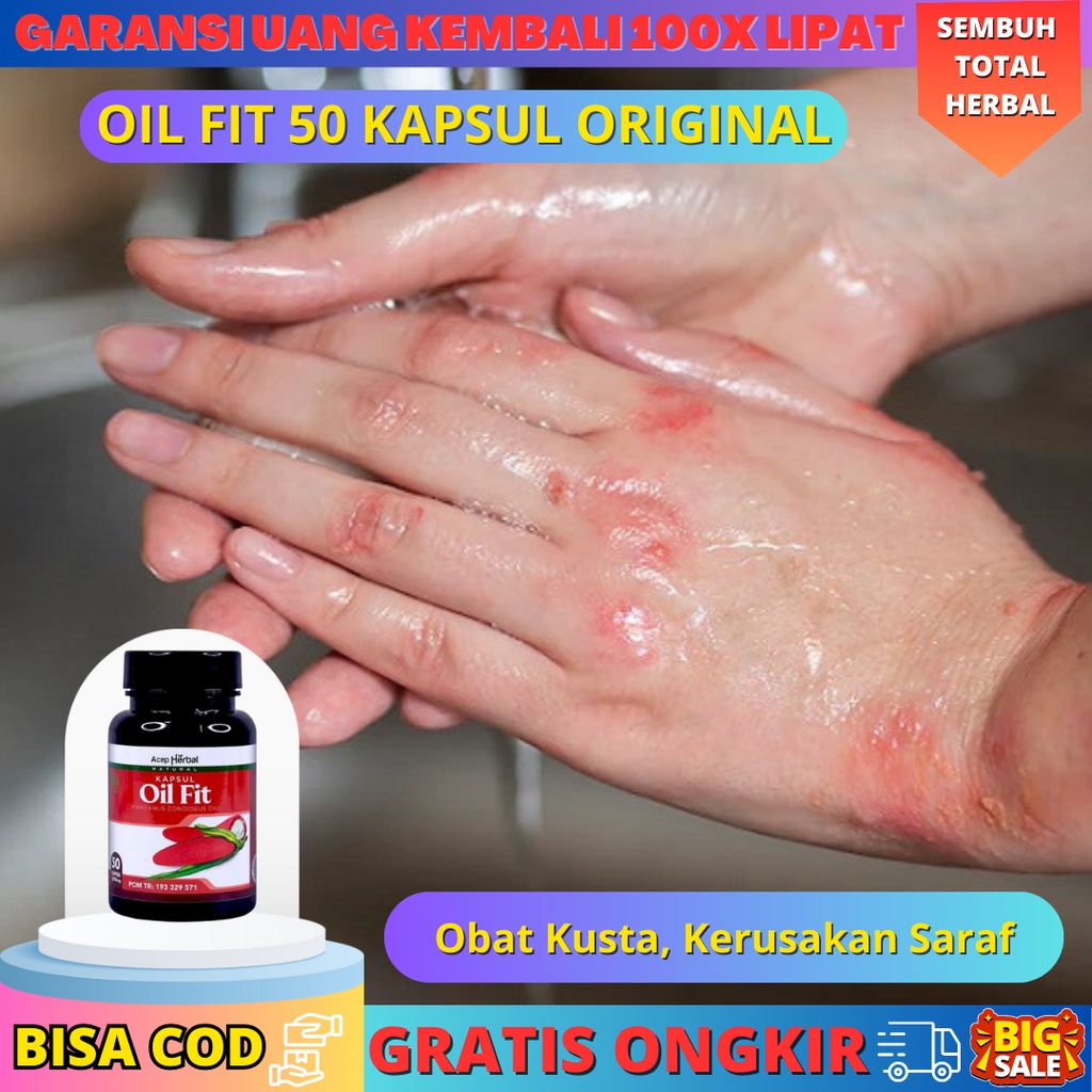 Oil Fit 50 Kapsul Untuk Obat Kusta, Kerusakan Saraf, Luka Pada Kulit, Melemahnya Otot, Mati rasa Oil