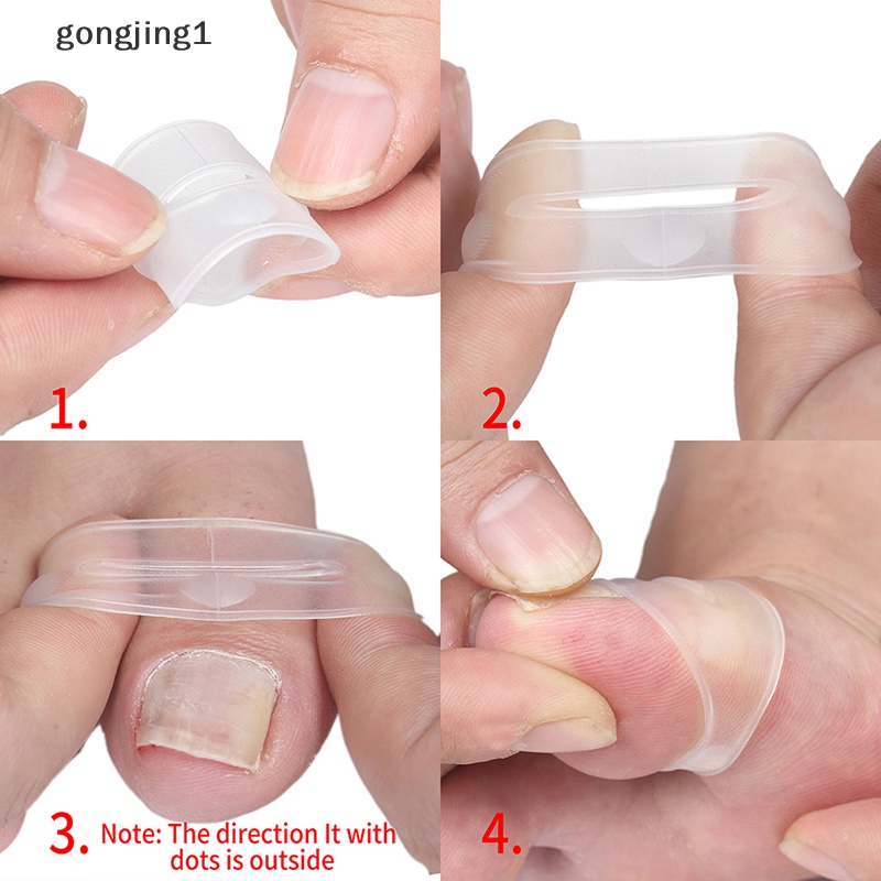 Ggg Alat Koreksi Kuku Kaki Silikon Invisible Ingrown Toe Nail Treatment ID