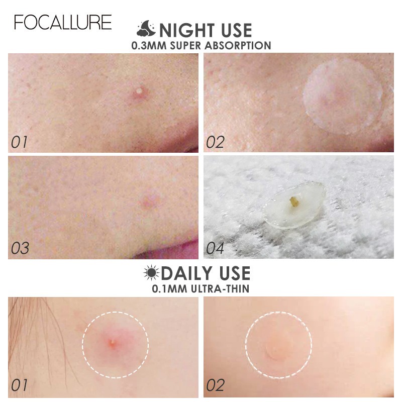 ★ BB ★ FOCALLURE Spot Patch Acne Treatment Day / Night - Pimple Patch - FA186 - FA 186
