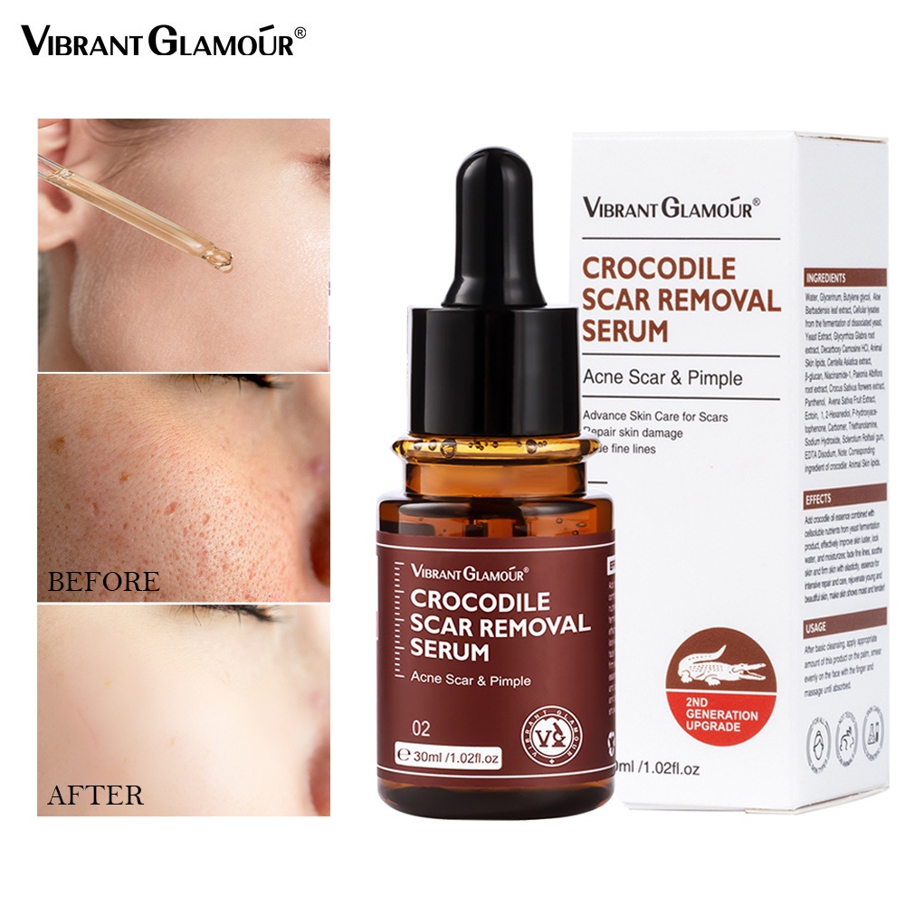 VIBRANT GLAMOUR Crocodile Penghilang Bekas Luka &amp; Scar Removal Serum - Secara Nyata Mengurangi Tampilan Bekas Luka,Jerawat Wajah &amp; Dark Spots -30ml