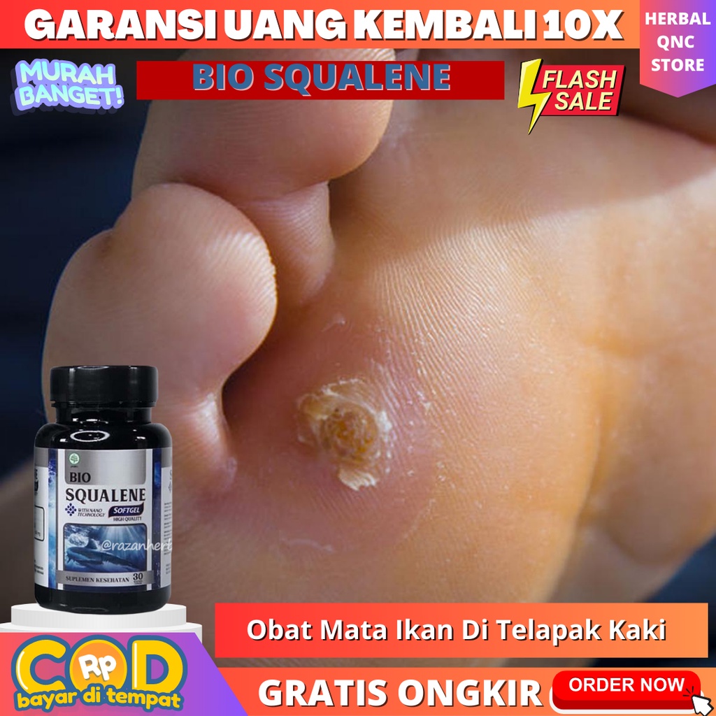 Obat Mata Ikan Di Telapak Kaki Dan Tangan Clavus Kapalan Kulit Menebal Kering Kaki Rayapan Pecah Pec