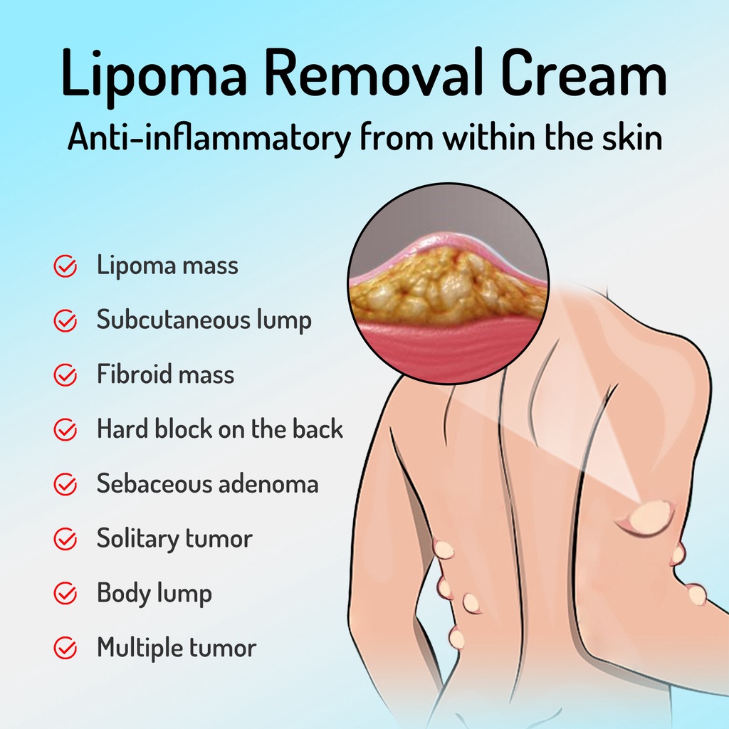 Obat Benjolan Lipoma Cream lipoma krim Obat Penghilang Benjolan Lipoma Obat Kista Ganglion, Obat Benjolan Lipoma Kanker Tumor Kelenjar Tiroid Lipoma 20Gr