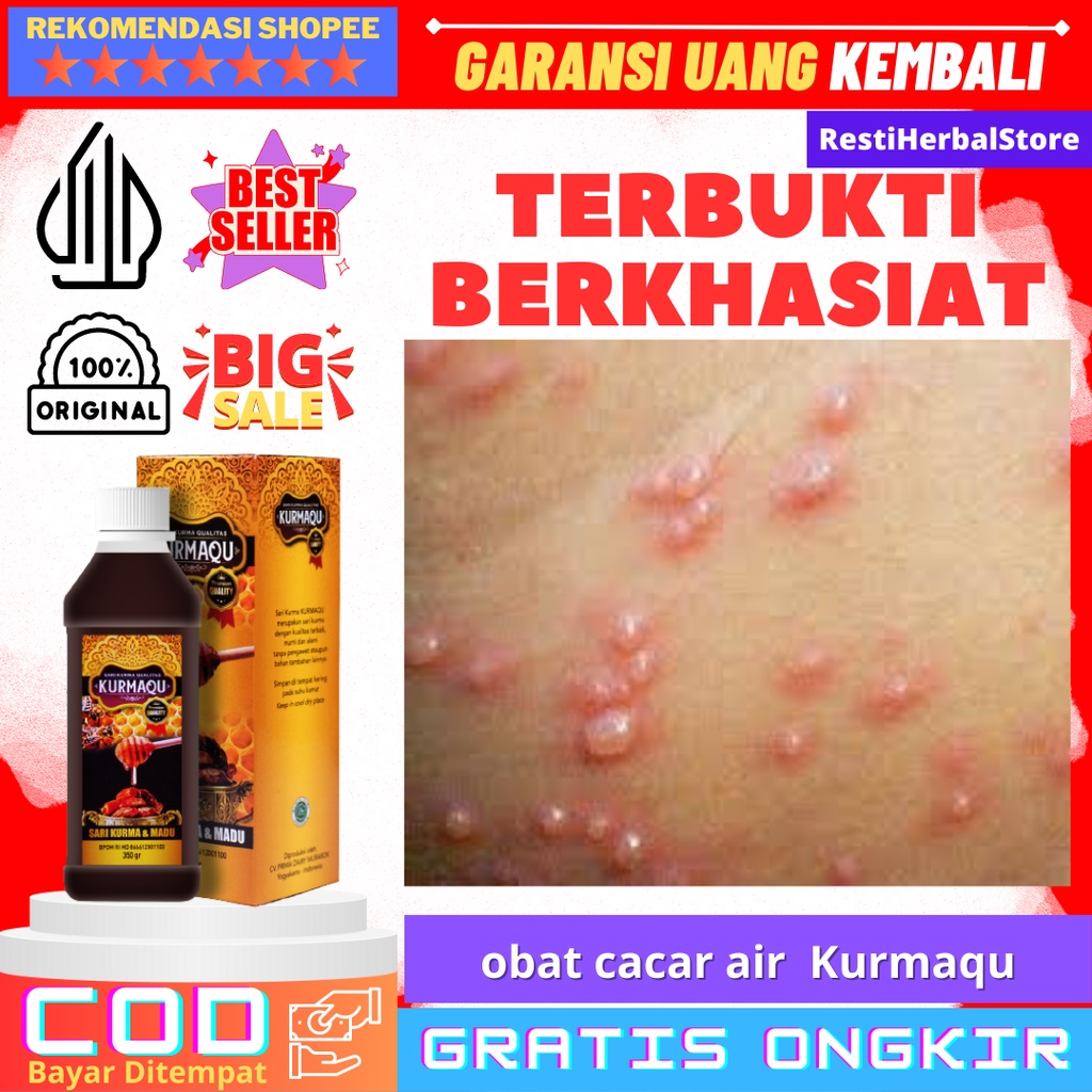 obat cacar air  Kurmaqu - Obat cacar air Obat Cacar Air Anak Dewasa Penghilang Bekas Cacar Tampek Ca