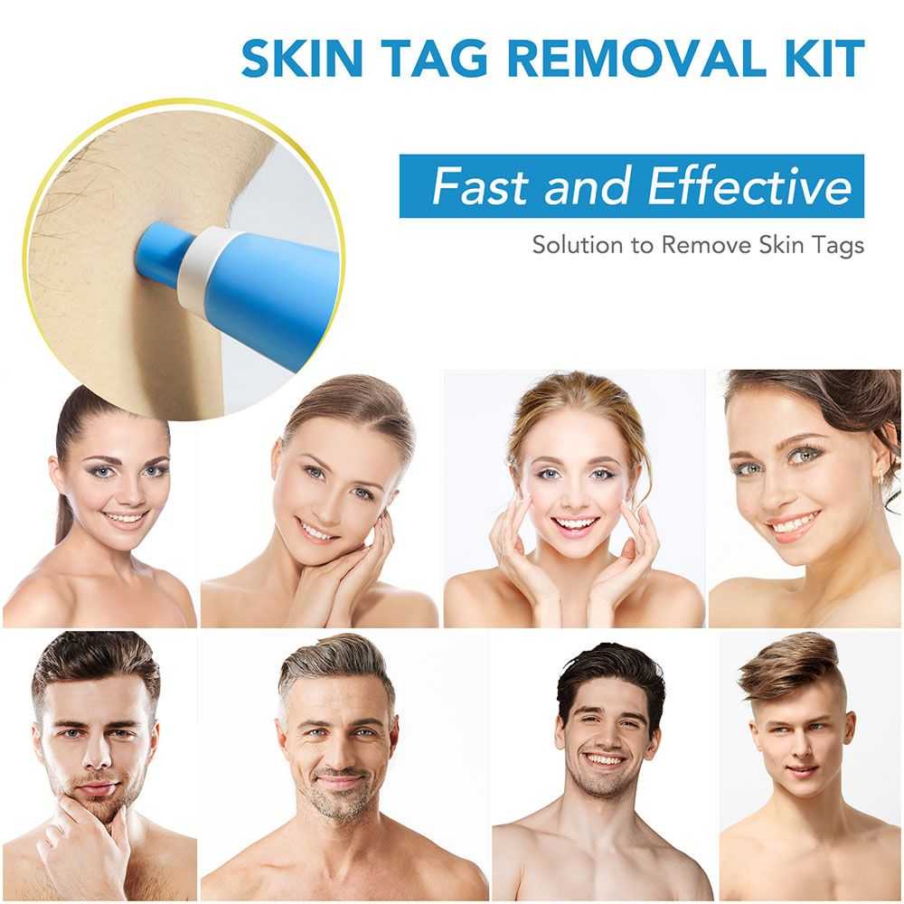 2in1 Wart Remover Removal Alat Penghilang Pembersih Kutil dan tahi lalat Leher Original Skin Tag Mole Removal Kit 2 in 1