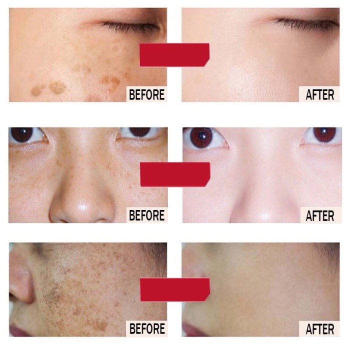 CINDYNAL Whitening Freckle Cream Remove Dark Spots Penghilang