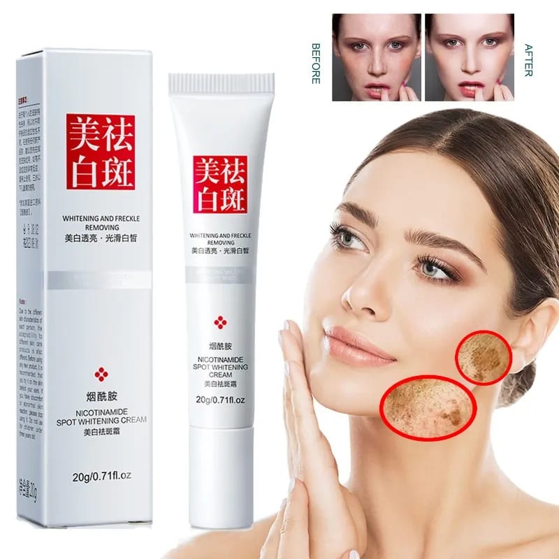 YOUBUY Whitening Freckle Cream Remove Dark Spots Anti Freckle Cream Niacinamide Fade Pigmentation Me