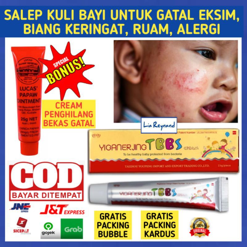 SALEP GATAL BAYI UNTUK GATAL RUAM ALERGI EKSIM KORENG GIGITAN SERANGGA BIANG KERINGAT XOD