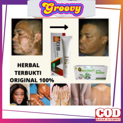 SALEP VITILIGO / OBAT VITILIGO / VITILIGO CREAM /  OBAT VITILIGO PALING AMPUH