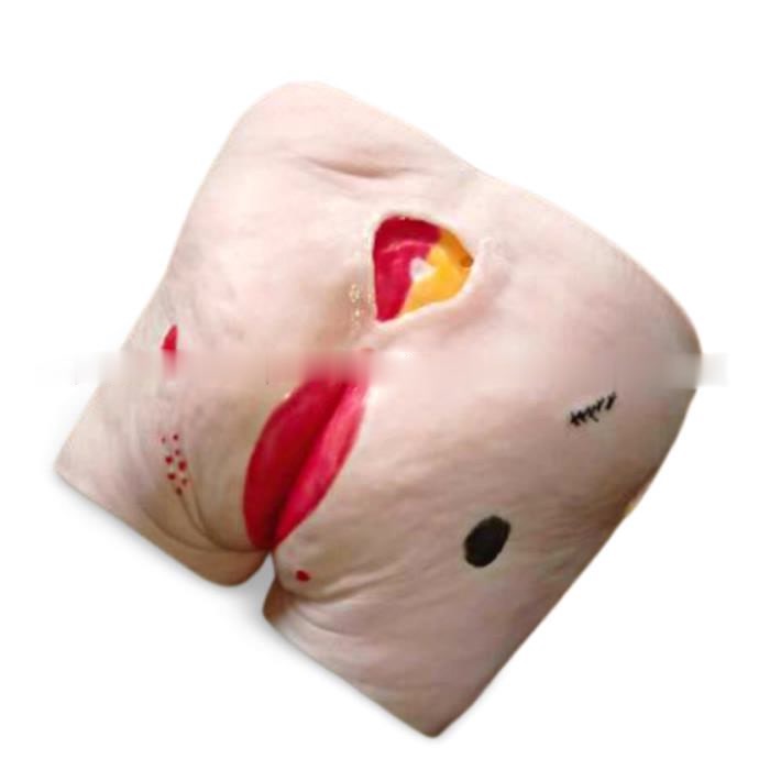 Dekubitus / Decubitus / Ulkus Dekubitus - Luka Baring (bedsores)