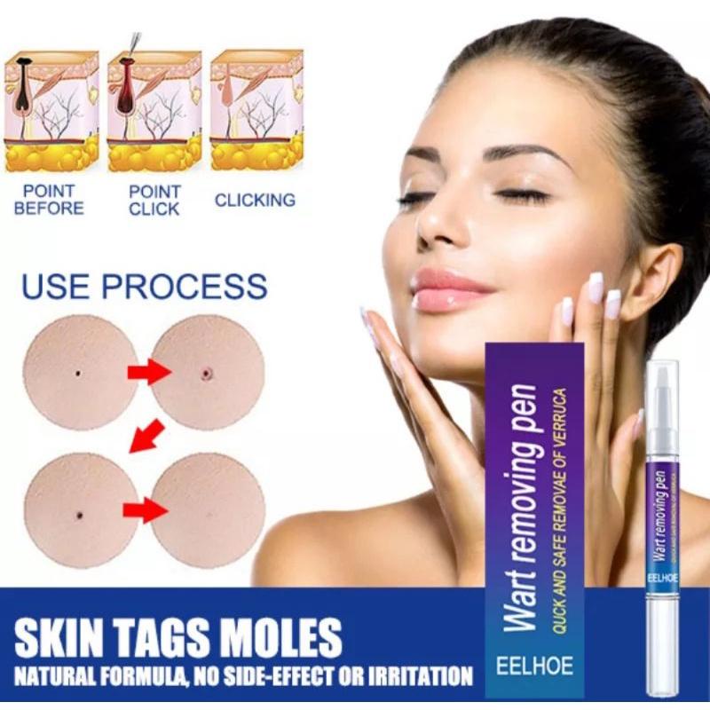 Cream Penghilang Tahi Lalat Kutil Ampuh EELHOE Tag // Wart Remover Pen Cream