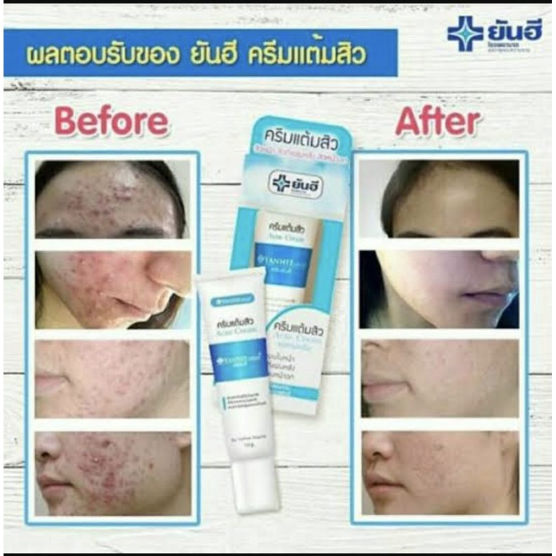 YANHEE YAN HEE ACNE CREAM | THE BEST ACNE CREAM FROM THAILAND