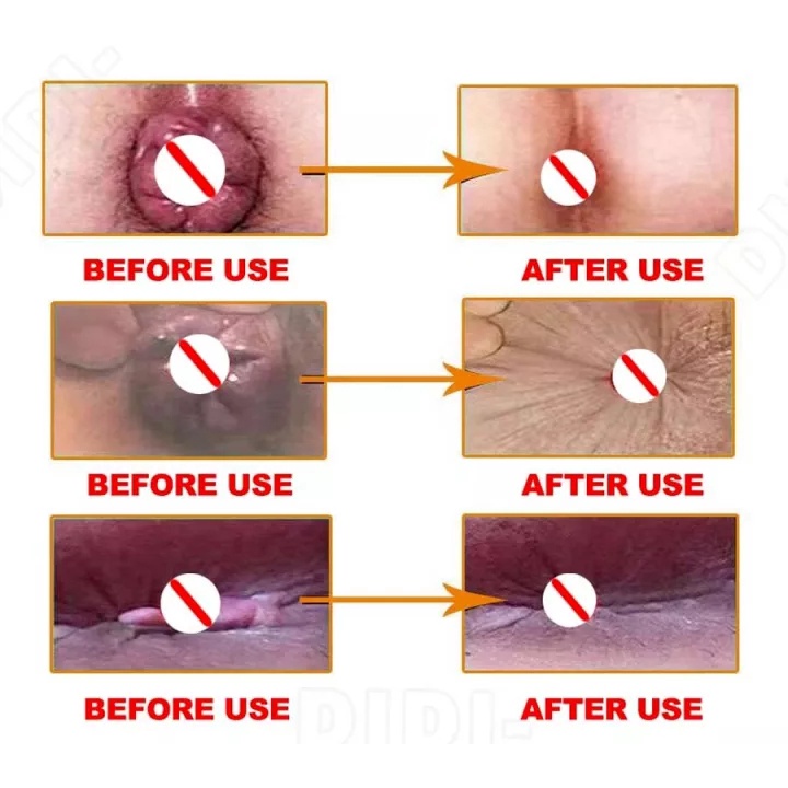 Sumifun Obat Wasir Obat Ambeien 20g Obat Benjolan Di Lubang Anus 100% Herbal Aman Ampuh Mengatasi Ambeien