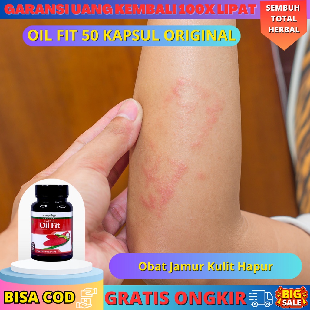 Obat Jamur Kulit Hapur - Obat Gatal2 - Obat Gatal Pada Kulit - Obat Gatal Gatal Pada Kulit Kaki - Ob