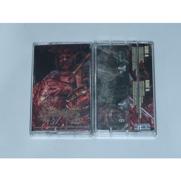 TAPE - CEPHALOTRIPSY - Uterovaginal Insertion Of Extirpated Anomalies (Fullprint)