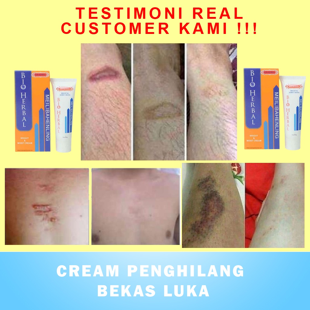 Penghilang Bekas Jerawat Luka Hitam Koreng dan Keloid Salep Cream Krim Penghilang Bekas Luka