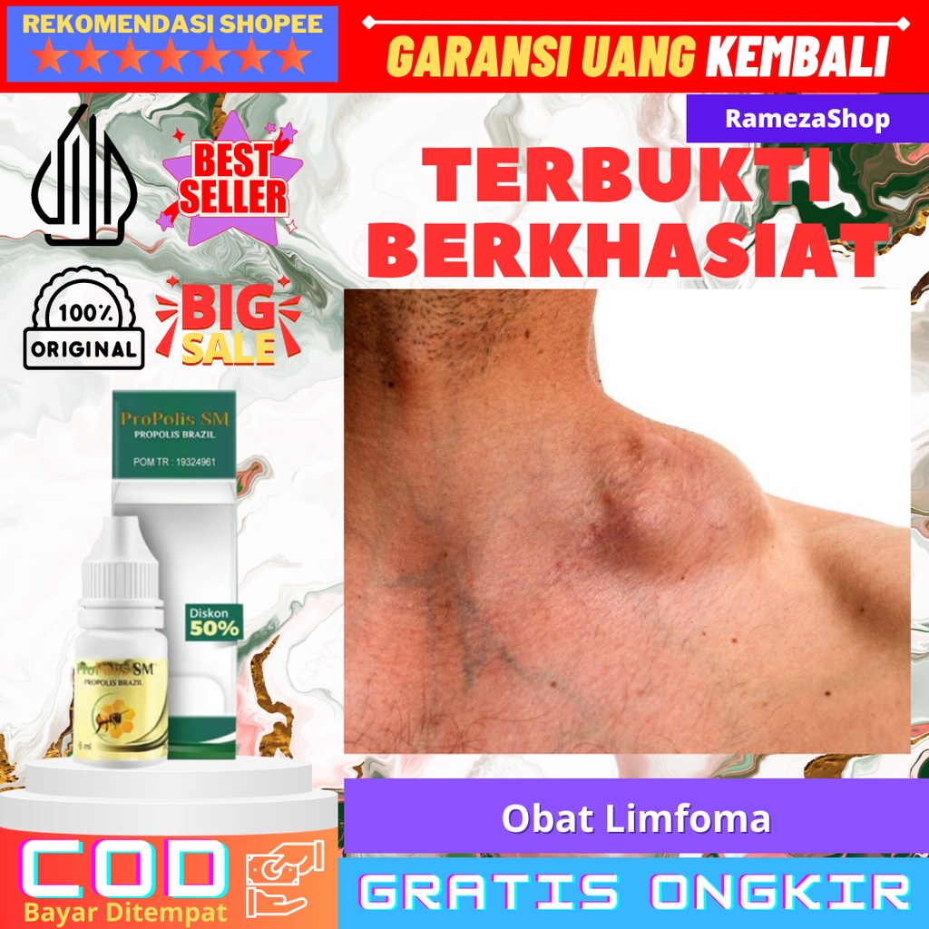 Obat Limfoma, Obat Pembengkakan Kelenjar Getah Bening Obat Herbal Pengempis Benjolan Lipoma, Limfoma