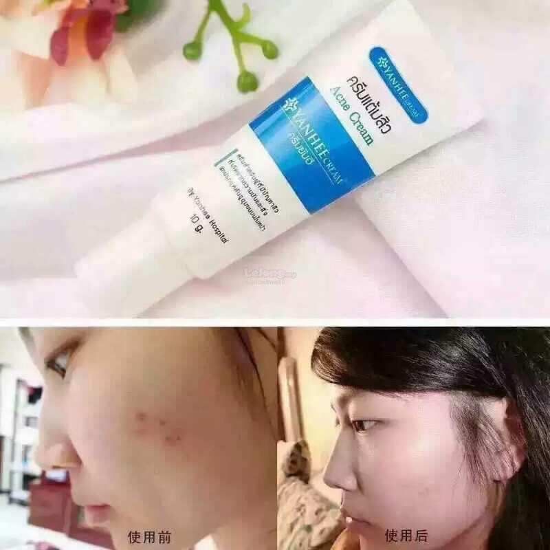 YANHEE YAN HEE ACNE CREAM | THE BEST ACNE CREAM FROM THAILAND