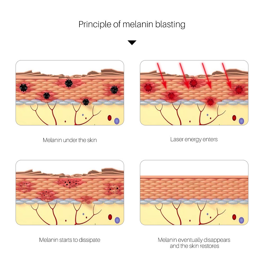 Picosecond Laser Biru Pen Penghilang Flek Hitam Laser Wajah/ Penghilang Tato/ Penghilang Kutil/ Penghilang Tai Lalat