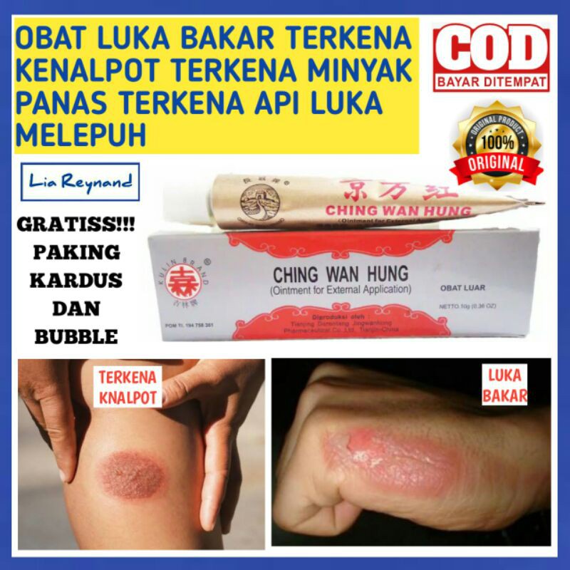 OBAT LUKA BAKAR TERKENA KENALPOT TERKENA MINYAK PANAS TERKENA API LUKA MELEPUH XOD