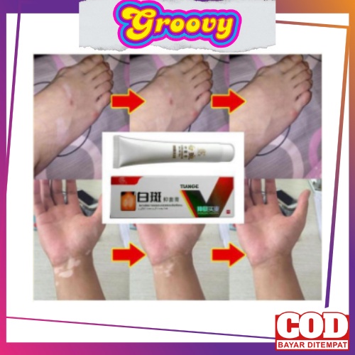 SALEP VITILIGO / OBAT VITILIGO / VITILIGO CREAM /  OBAT VITILIGO PALING AMPUH