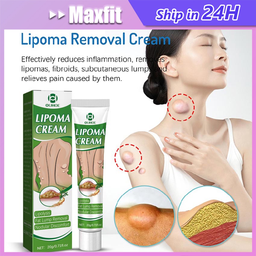 OUHOE 20G Salep Lipoma Salep Benjolan Paling Ampuh Obat Benjolan Lipoma Penghilang Benjolan Aman Dan