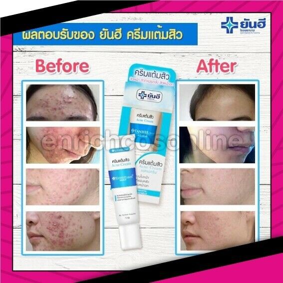 YANHEE YAN HEE ACNE CREAM | THE BEST ACNE CREAM FROM THAILAND