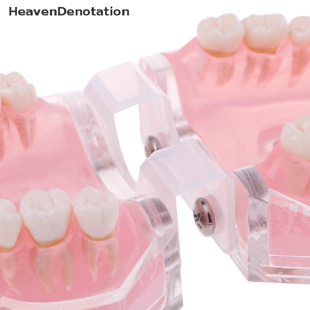 [HeavenDenotation] Plastik typodont orthodontic model Standar4004Dengan 28gigi Lepas HDV