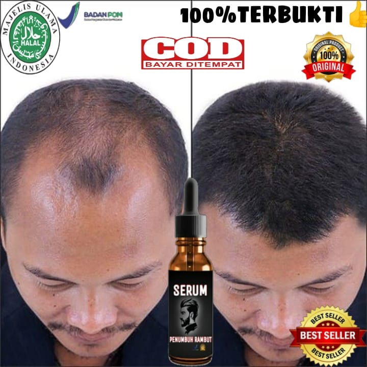 Penumbuh rambut cepat/Penumbuh rambuh botak super cepat/penumbuh rambut secara cepat panjang/penumbu
