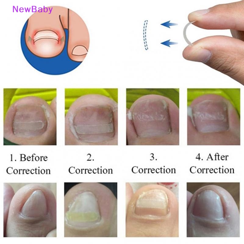 Newbaby 10buah/set Braket patch Koreksi Kuku Kaki patch pedicure ID