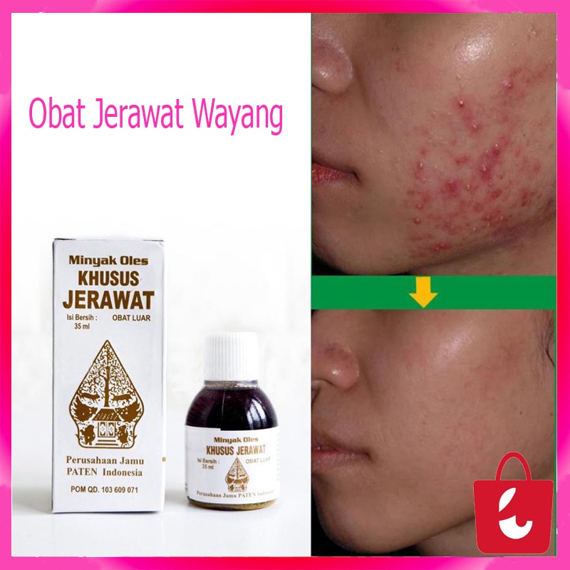 [100% Asli] Obat Jerawat Wayang Original BPOM Minyak Oles Khusus Jerawat Cap Wayang