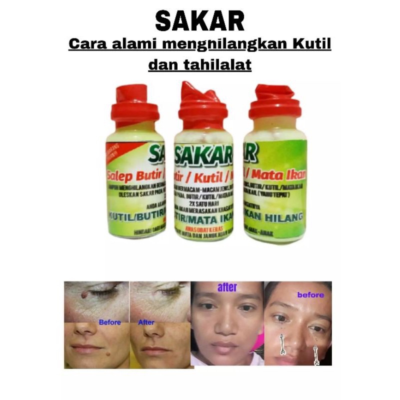 Sakar Obat Kalimantan Penghilang Kutil Tahi Lalat , Butir &amp; Mata Ikan