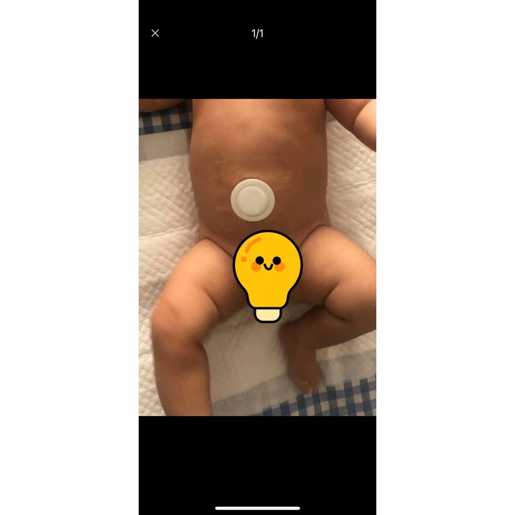 KOYO HERBAL HERNIA ANAK / PUSAR BODONG / Infant Umbilical HERNIA Patch / Koyo Herbal Bayi Anak / Stiker Hernia Bayi / Manjur