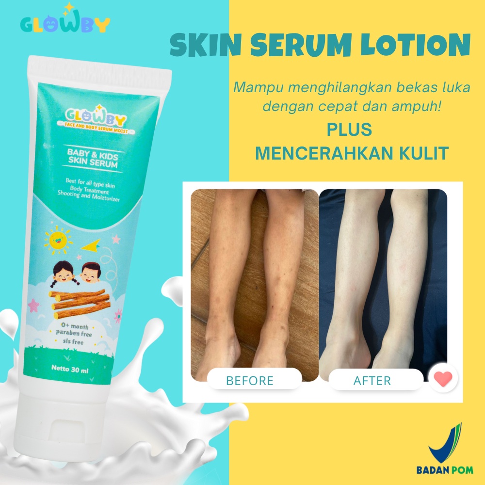 WD64RF (GLOWBY) Serum Lotion Penghilang bekas luka Anak