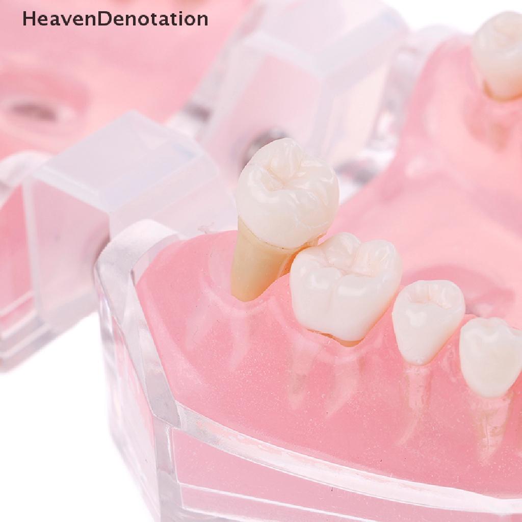 [HeavenDenotation] Plastik typodont orthodontic model Standar4004Dengan 28gigi Lepas HDV