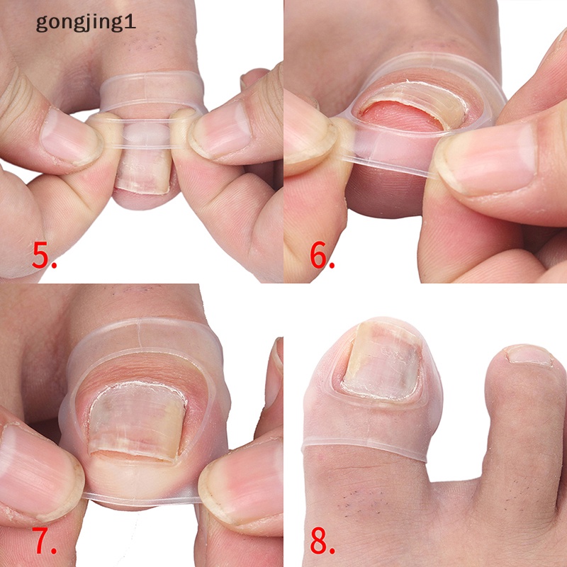 Ggg Alat Koreksi Kuku Kaki Silikon Invisible Ingrown Toe Nail Treatment ID